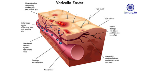 chickenpox virus Varicella zoster